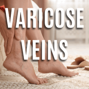 Varicose Veins App