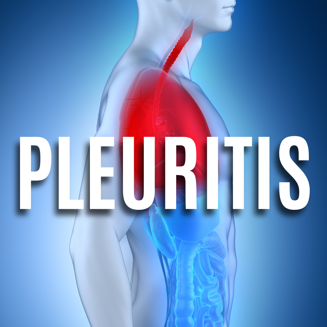 Pleuritis