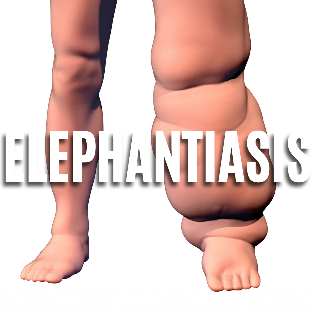 Elephantiasis
