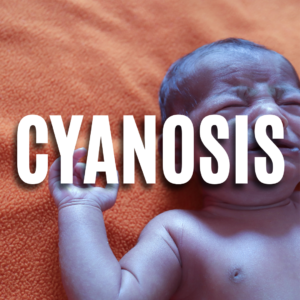 Cyanosis  QUIZ