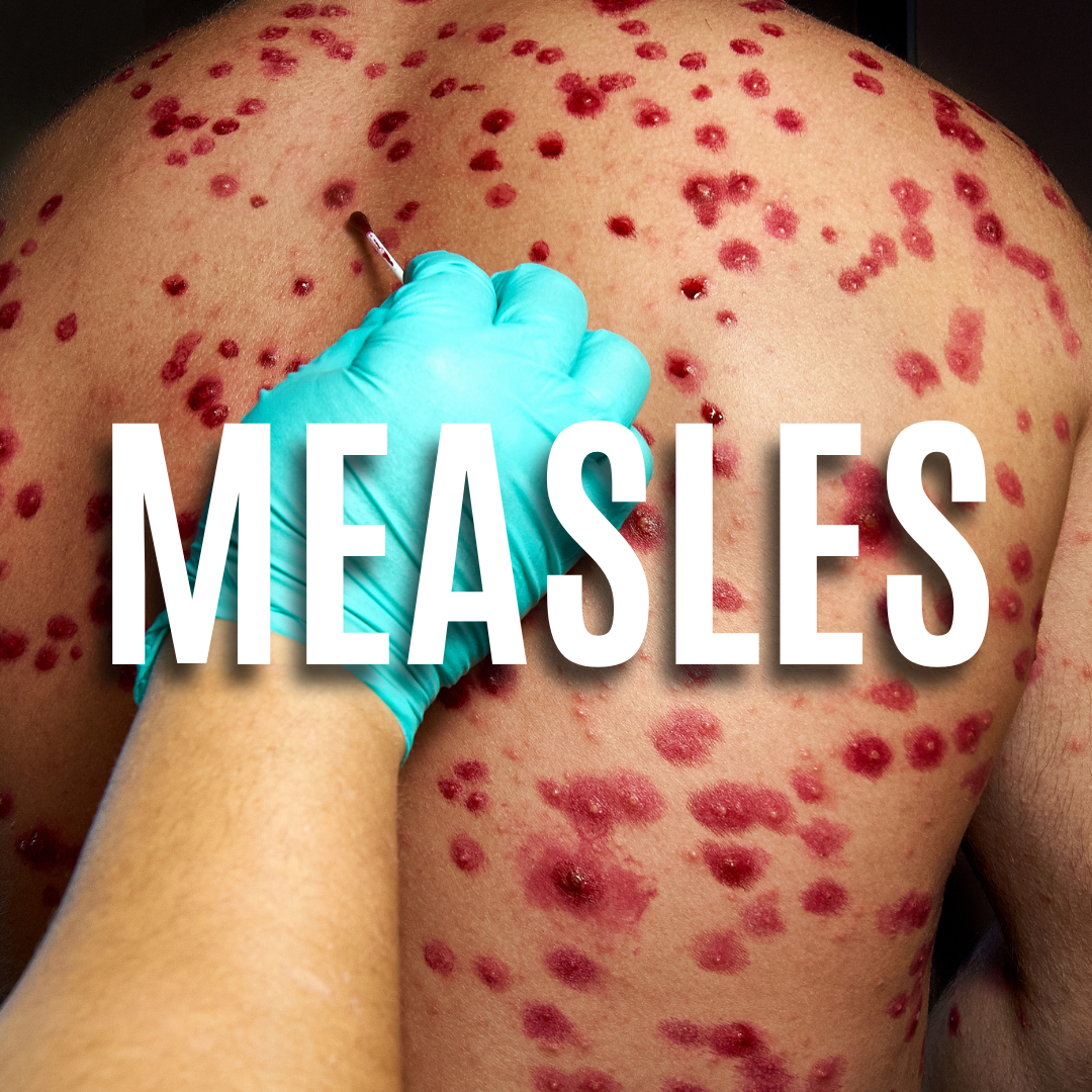 Measles QUIZ